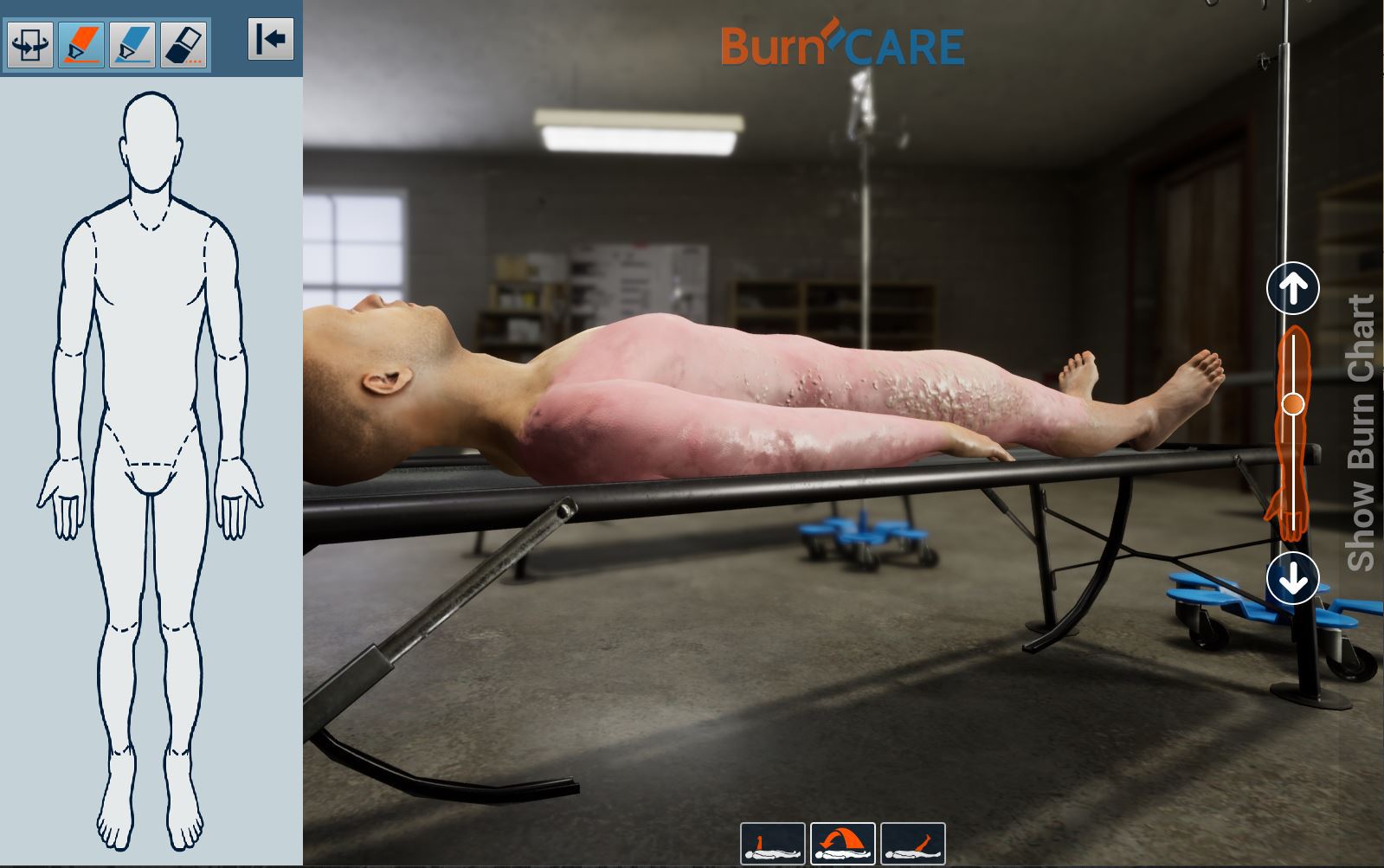 Read more about the article BurnCARE: Burn Computer Application for Research and Education